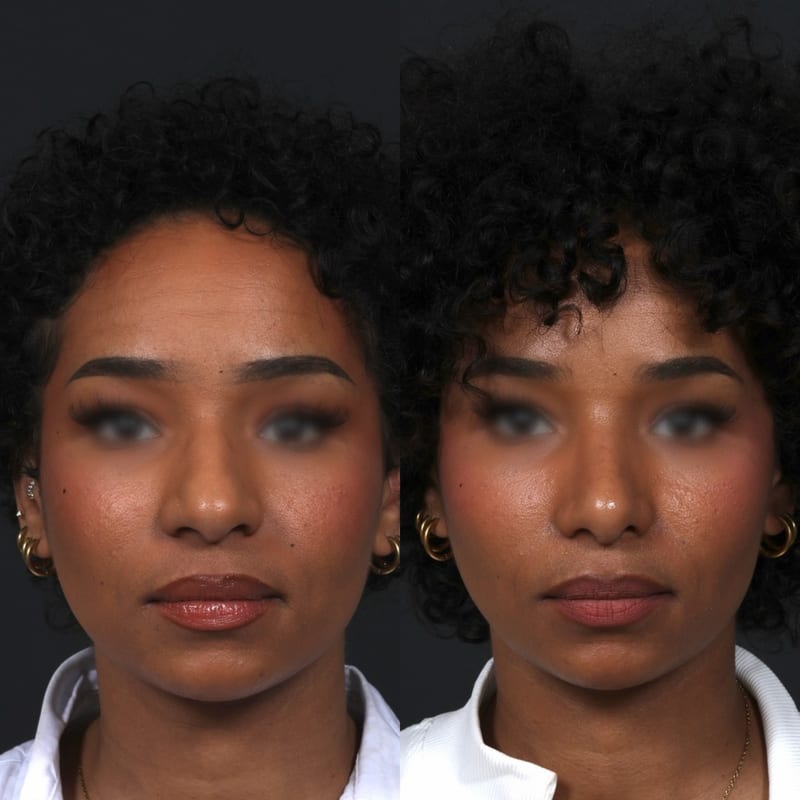 Rhinoplastie ethnique avant après — affinement du nez en préservant l'identité