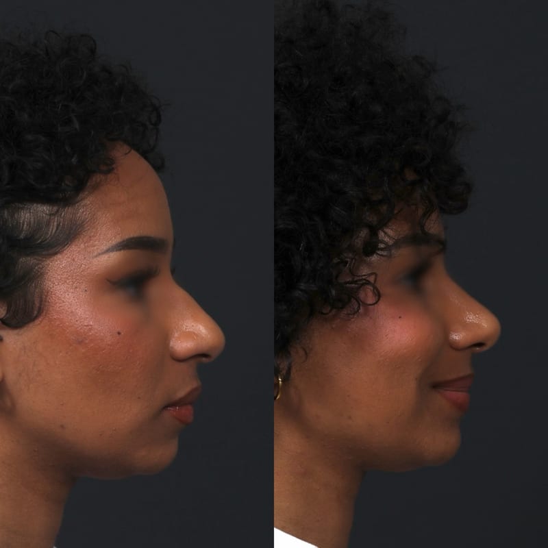 Rhinoplastie ethnique avant après — harmonisation de la pointe et du dos du nez