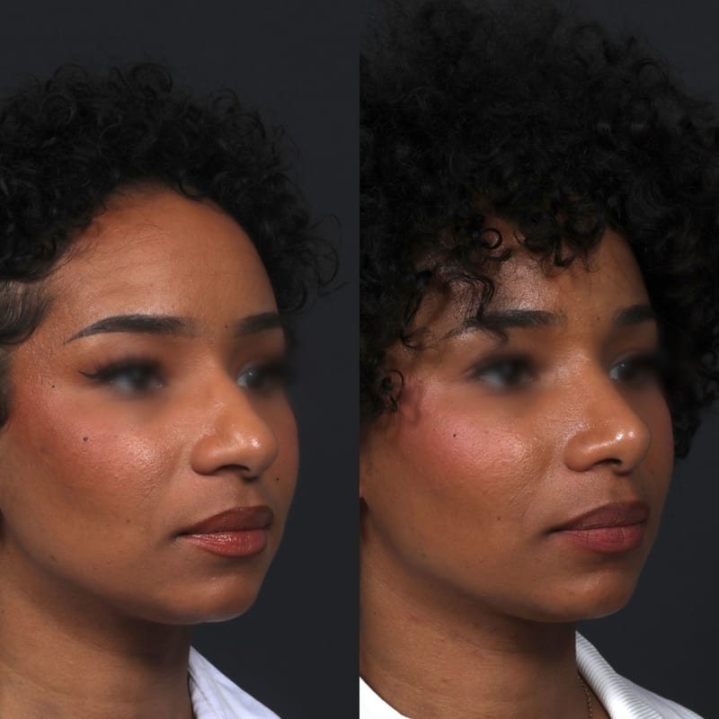 Rhinoplastie ethnique avant après — résultat naturel respectant les traits du visage