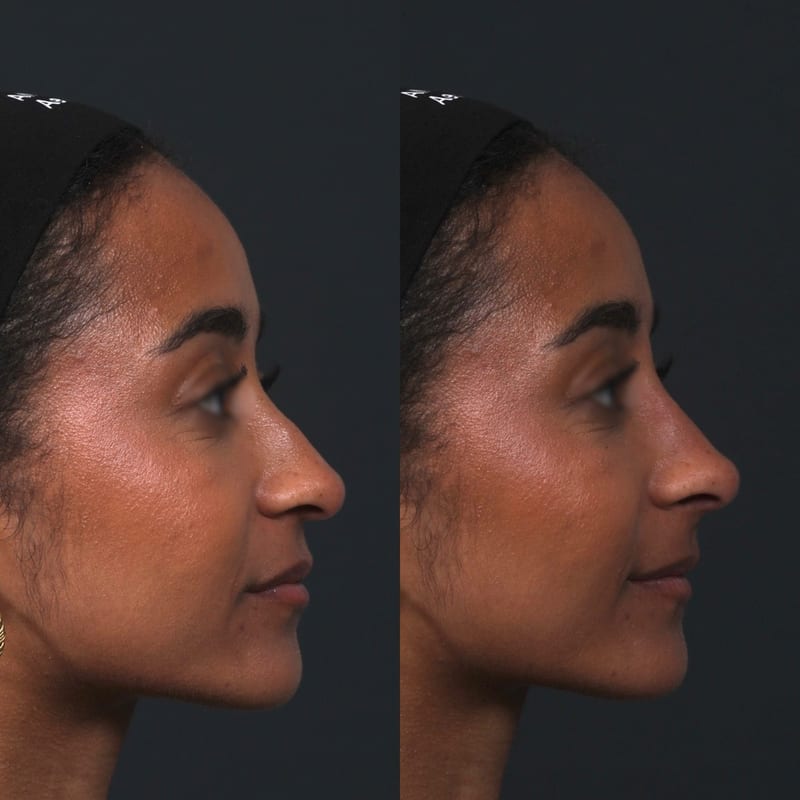 Rhinoplastie médicale avant après de profil — injection d'acide hyaluronique