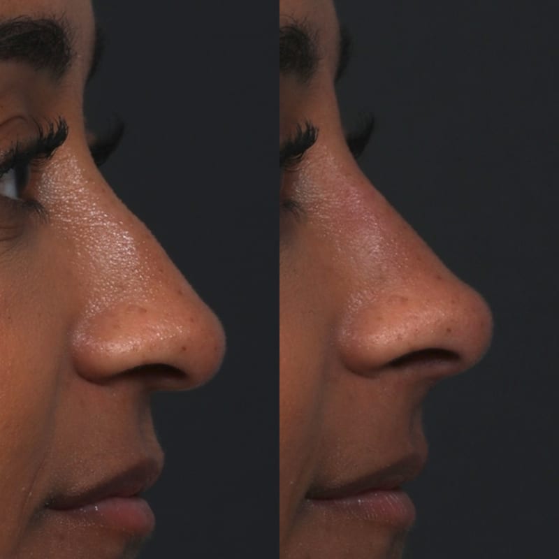 Rhinoplastie médicale avant après — gros plan du nez de profil