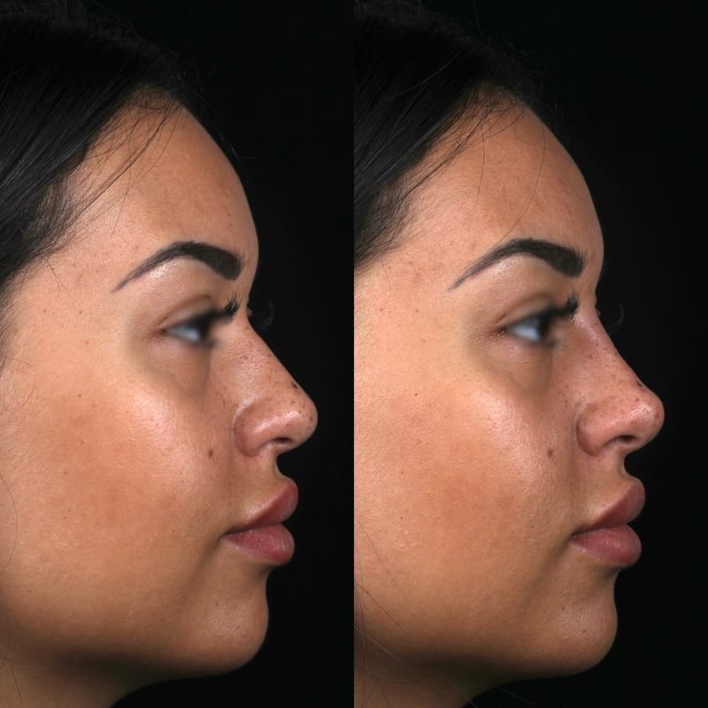 Rhinoplastie médicale avant après de profil — comblement d'une bosse