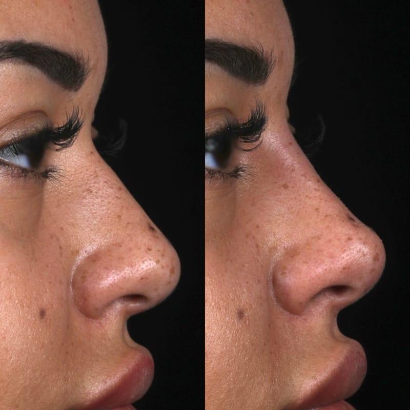 Rhinoplastie médicale avant après — gros plan du nez