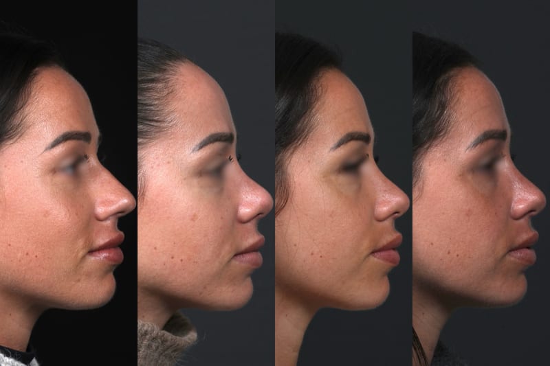Rhinoplastie sur peau épaisse — évolution du profil au fil des mois, affinement progressif de la pointe