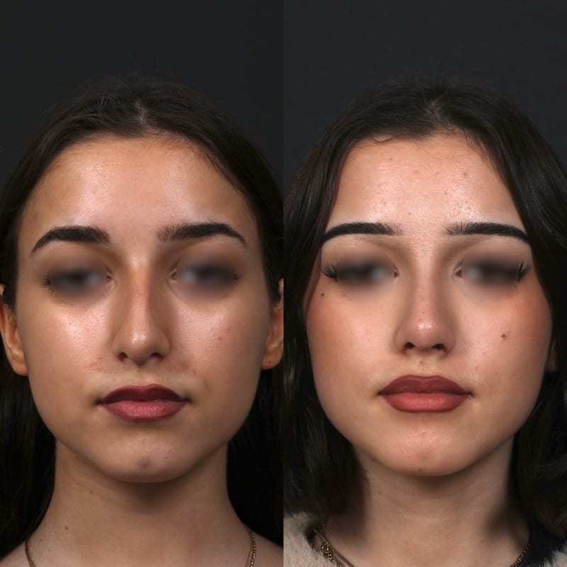Rhinoplastie vue de face, avant/après — réduction de bosse et affinement