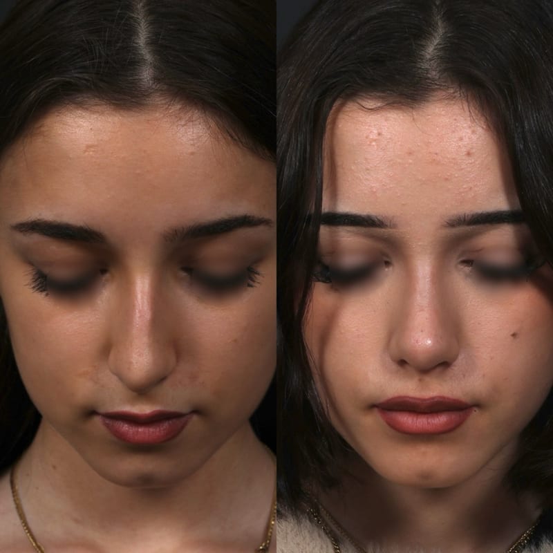 Rhinoplastie vue de face (tête penchée), avant/après — réduction de bosse et affinement