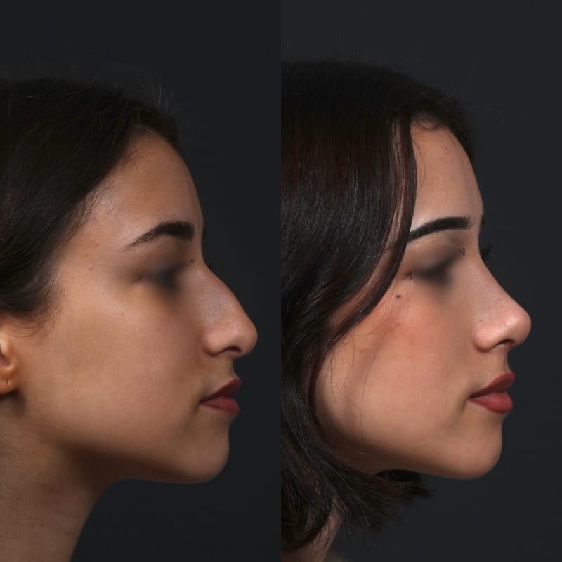 Rhinoplastie avant après de profil