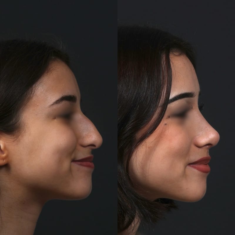 Rhinoplastie vue de profil, avant/après — lignes du dos harmonisées