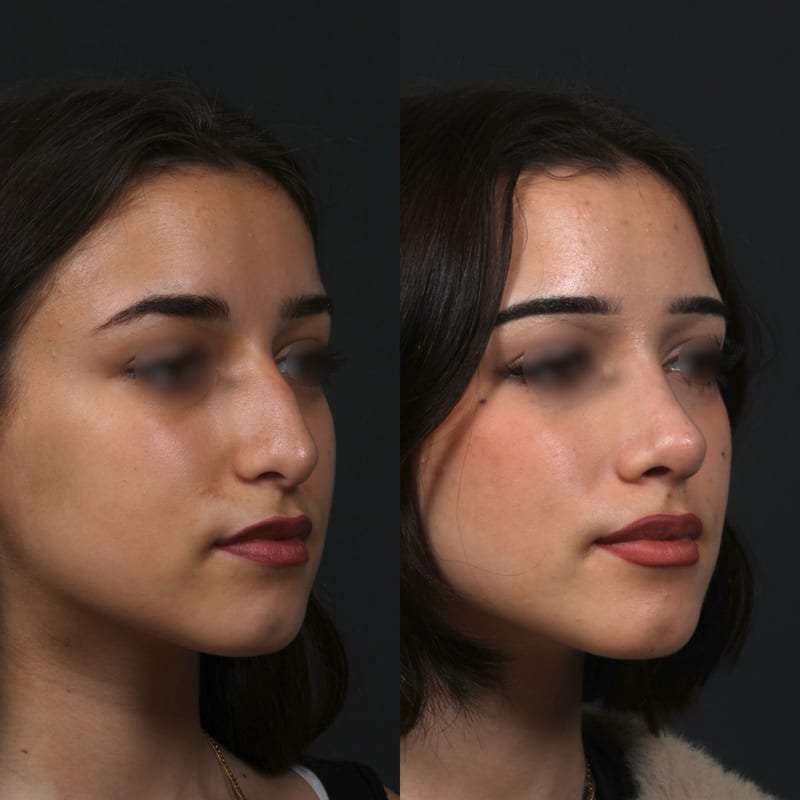 Rhinoplastie vue de trois-quarts, avant/après — équilibre global de la pyramide nasale