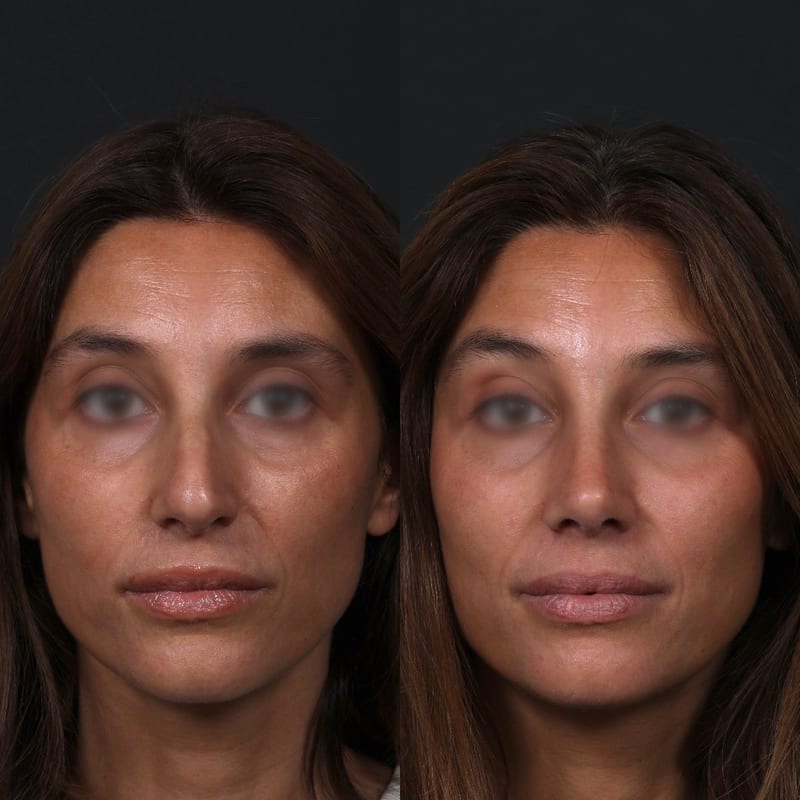 Rhinoplasty front view, before/after — nose refinement and harmonised lines