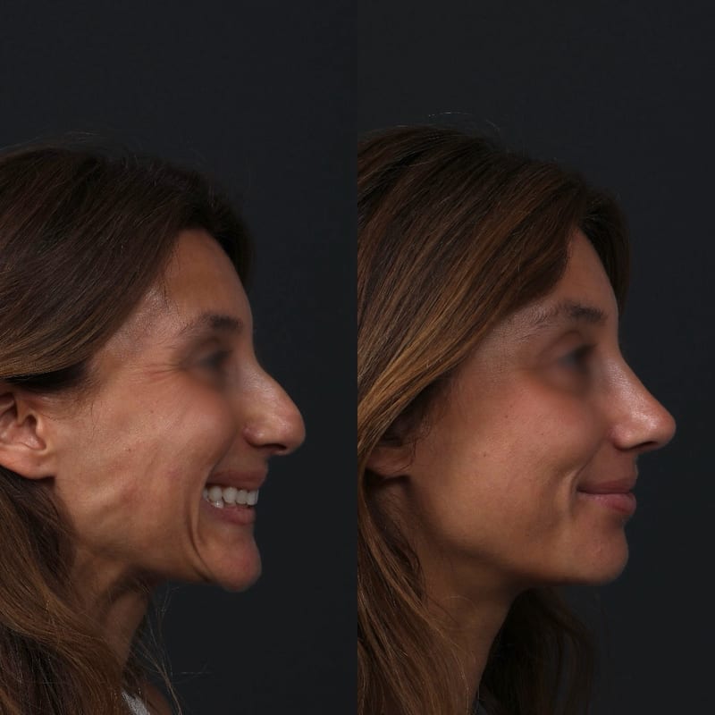 Rhinoplasty profile view, before/after — drooping tip corrected, profile softened when smiling
