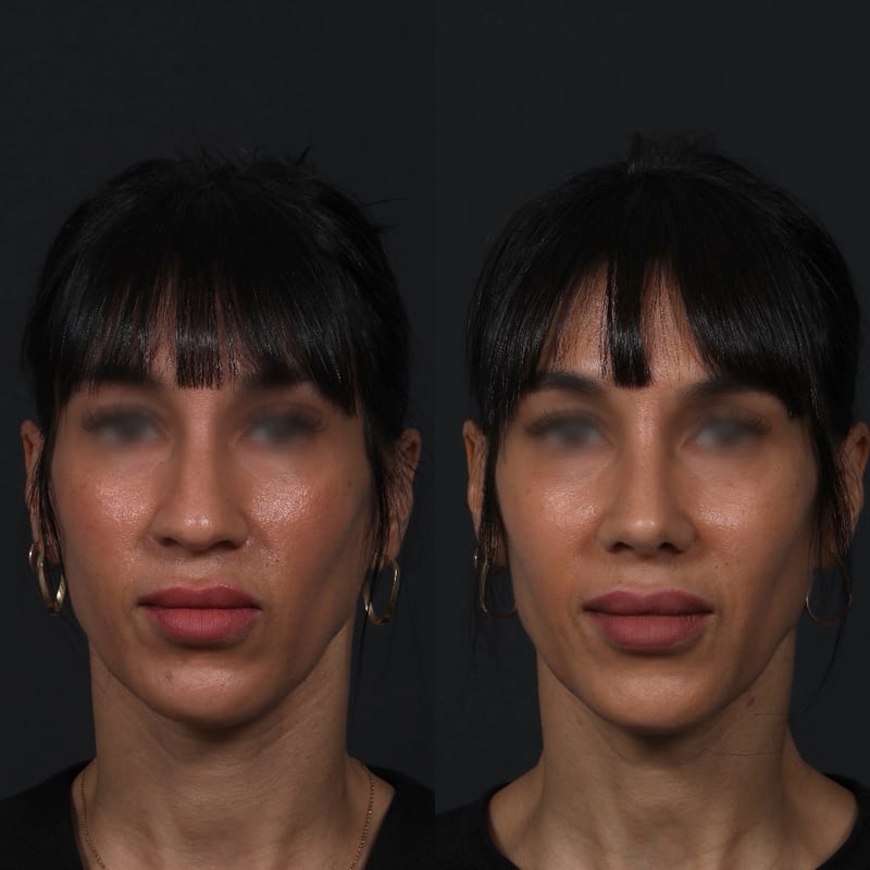 Rhinoplastie vue de face, avant/après — nez affiné et lignes plus droites