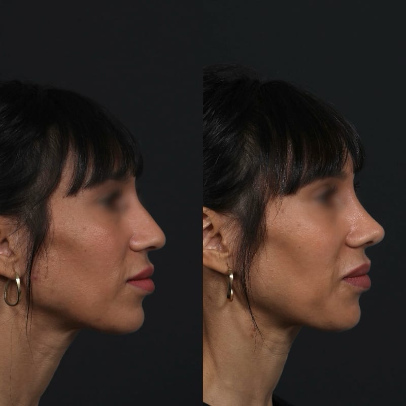 Rhinoplastie vue de trois-quarts, avant/après — bosse du dos réduite et pointe soutenue