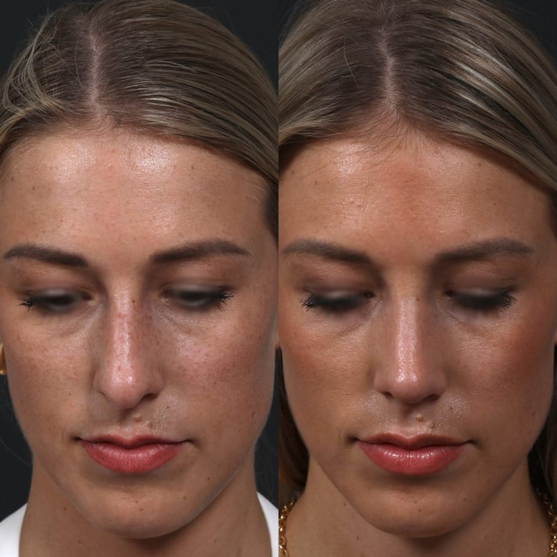 Rhinoplastie vue de face (tête penchée), avant/après — lissage du dos et pointe affinée