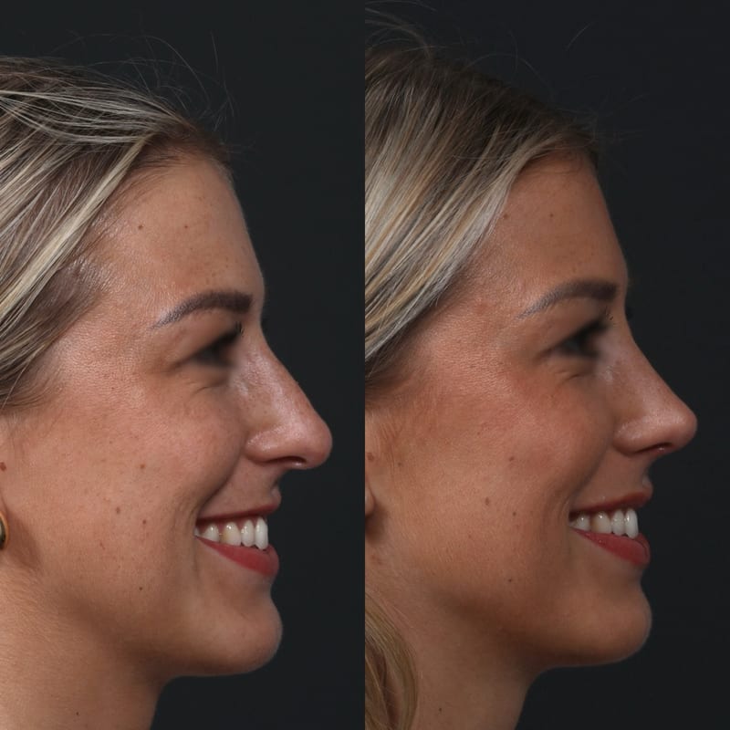 Rhinoplastie vue de profil, avant/après — lissage du dos et pointe affinée