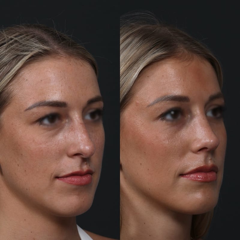 Rhinoplastie vue de trois-quarts, avant/après — dos assoupli et pointe affinée