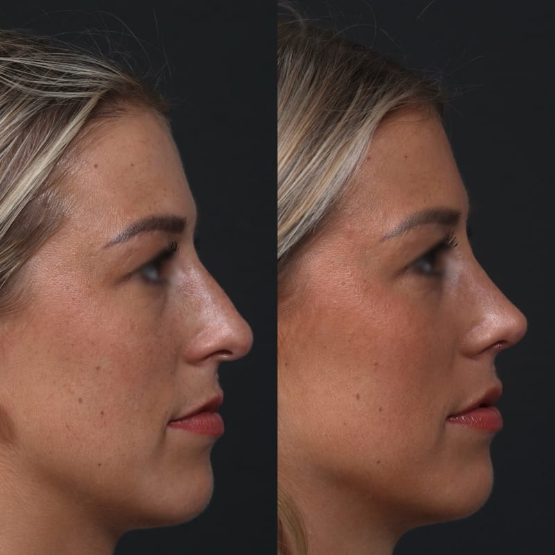 Rhinoplastie vue de profil, avant/après — pointe redéfinie et soutenue