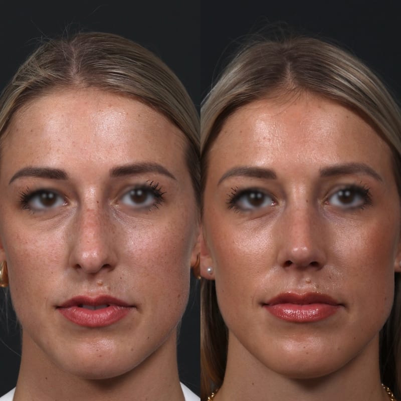 Rhinoplastie vue de face, avant/après — affinement naturel
