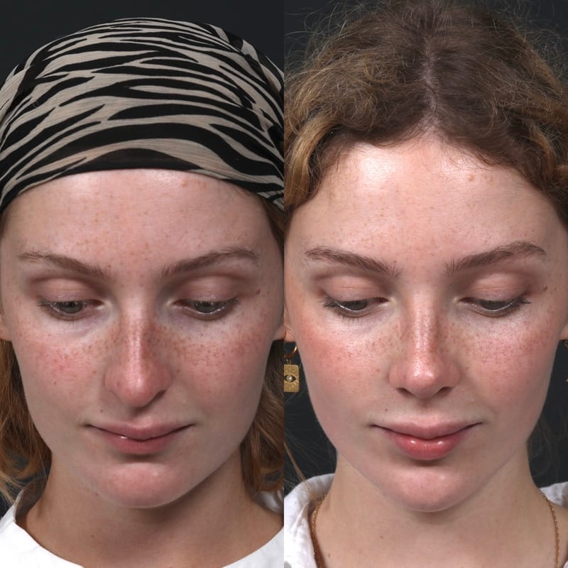Rhinoplastie vue de face (tête penchée), avant/après — affinement subtil