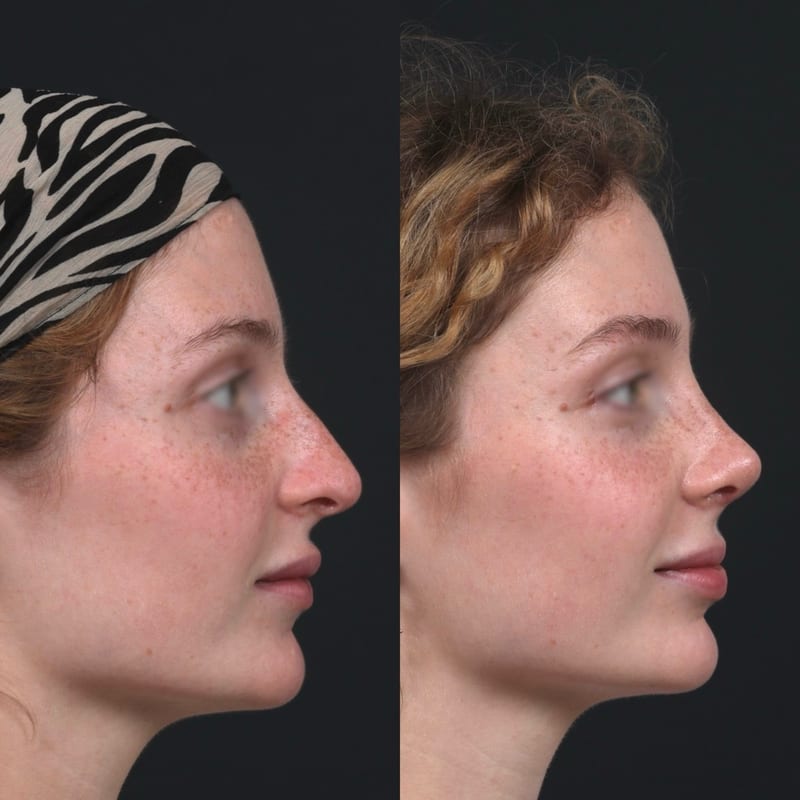 Rhinoplastie vue de profil, avant/après — affinement subtil