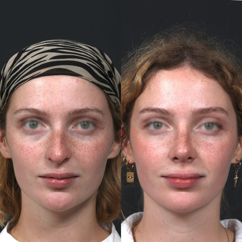 Rhinoplastie avant après de face