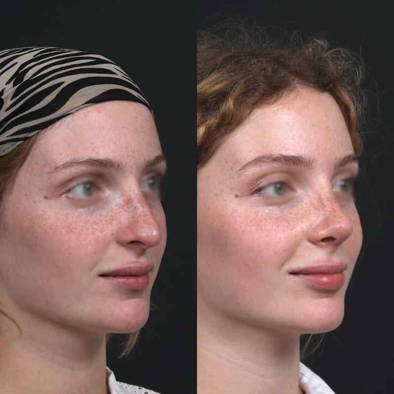 Rhinoplastie vue de trois-quarts, avant/après — pointe redessinée avec discrétion
