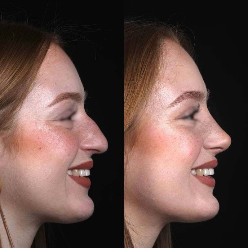 Rhinoplastie vue de profil, avant/après — profil rectiligne et pointe définie