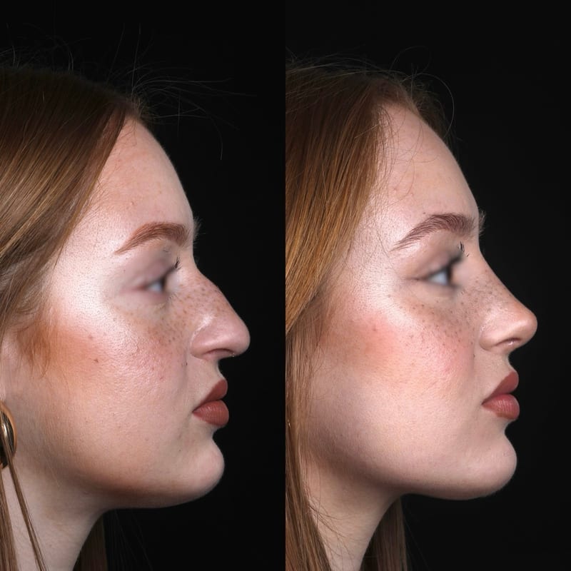 Rhinoplastie vue de profil, avant/après — réduction de bosse, profil rectiligne