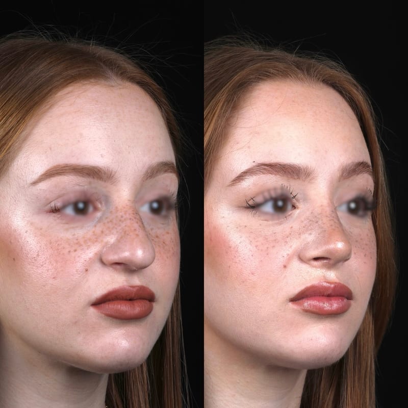 Rhinoplastie vue de trois-quarts, avant/après — équilibre du profil et soutien de la pointe