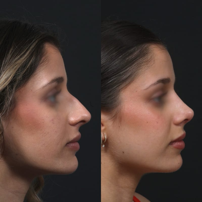 Rhinoplastie vue de profil, avant/après — réduction de bosse et rotation de pointe