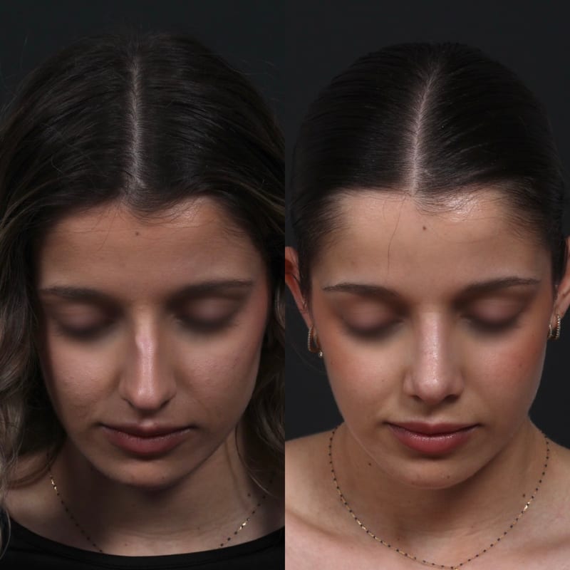Rhinoplastie vue de face (tête penchée), avant/après — réduction de bosse et rotation de pointe