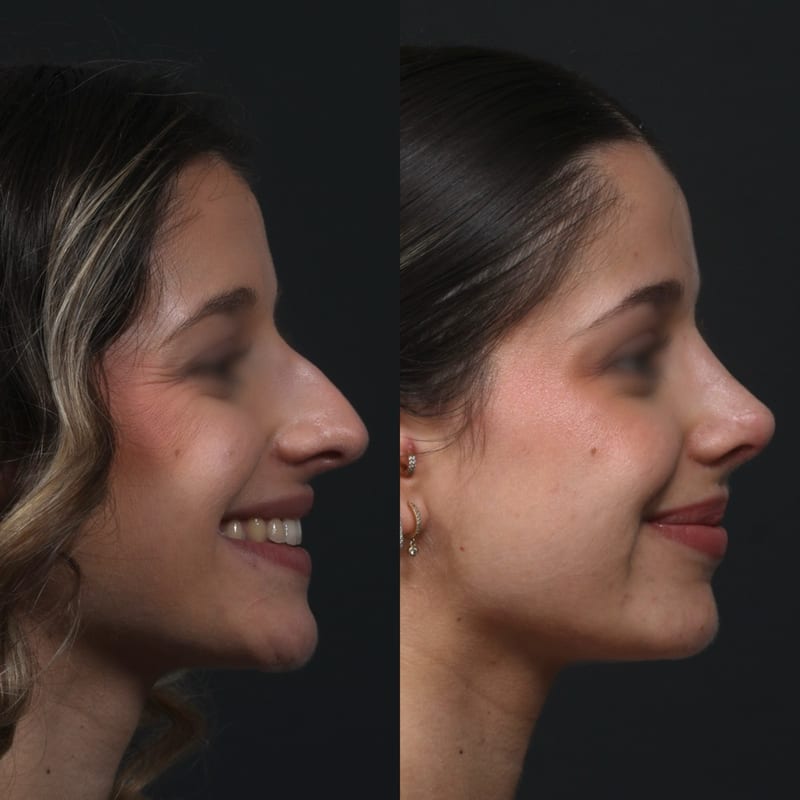Rhinoplastie vue de trois-quarts, avant/après — profil adouci sur le sourire