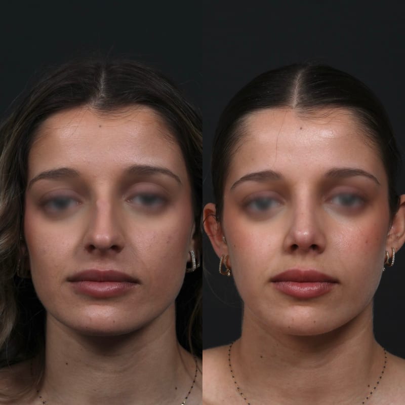 Rhinoplastie vue de face, avant/après — pointe affinée et mieux projetée