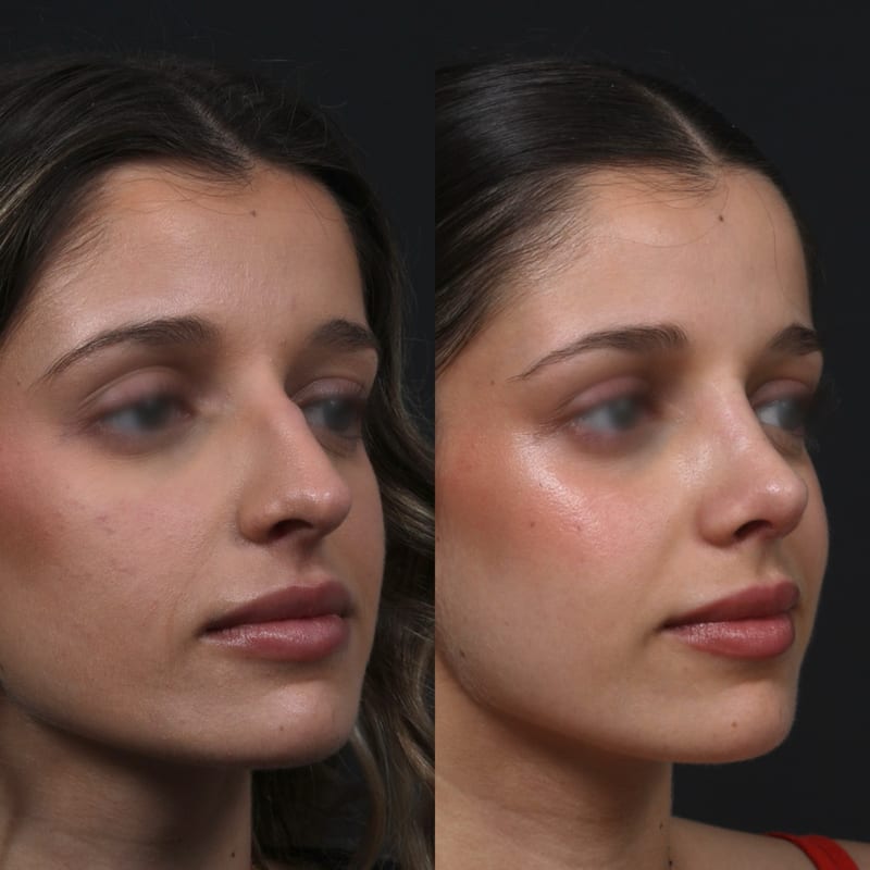 Rhinoplastie vue de trois-quarts, avant/après — ligne de profil rectiligne