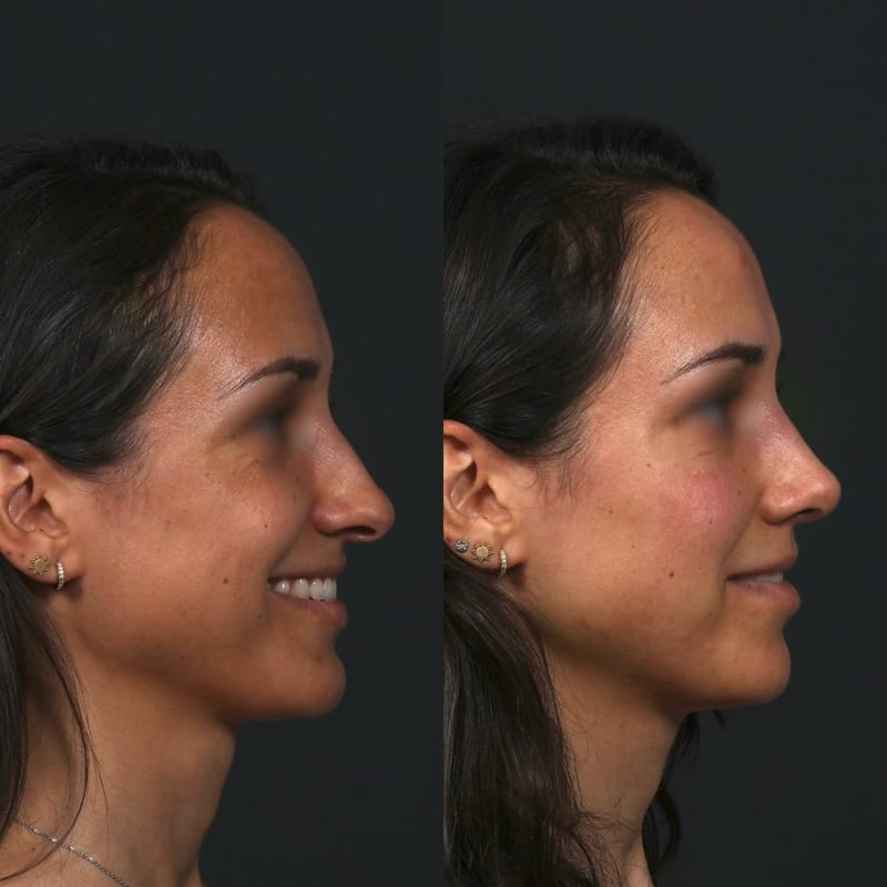 Rhinoplastie avant après de trois-quarts