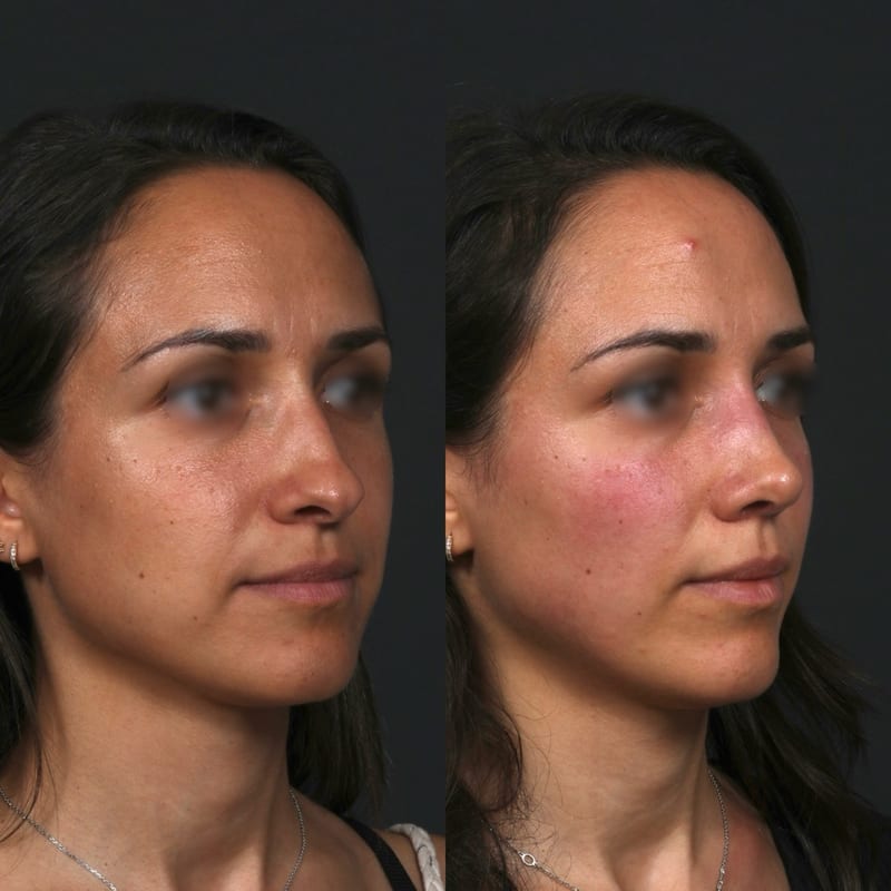 Rhinoplastie vue de trois-quarts, avant/après — dos lissé et profil épuré
