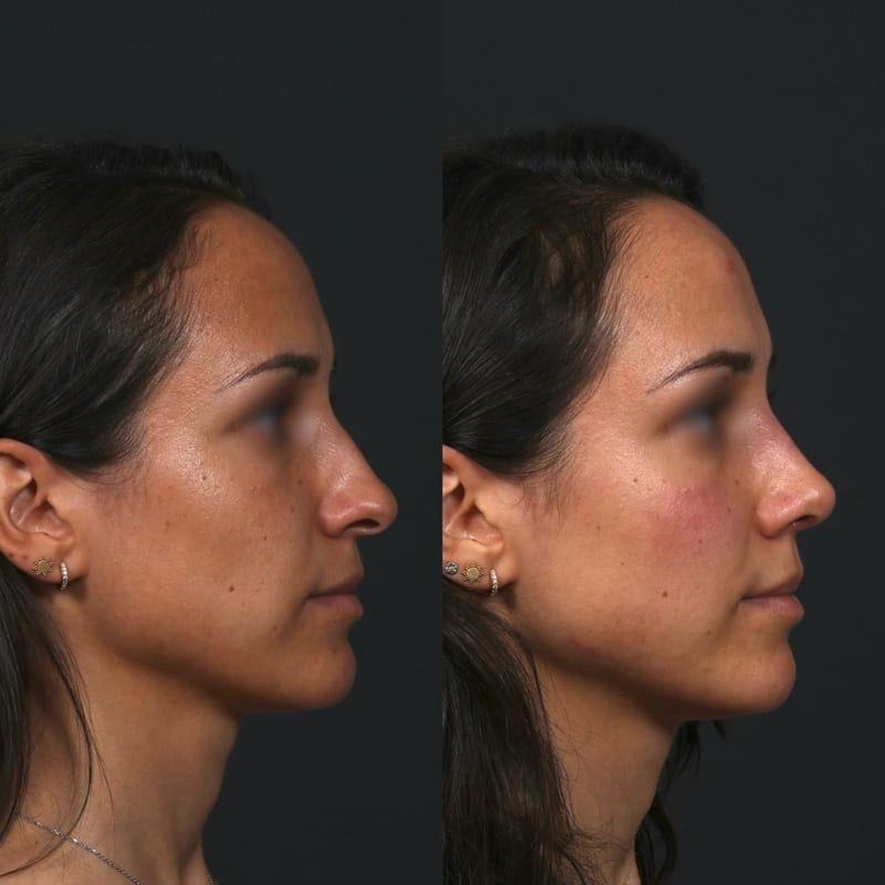 Rhinoplastie vue de profil, avant/après — profil rectiligne, transition front-nez
