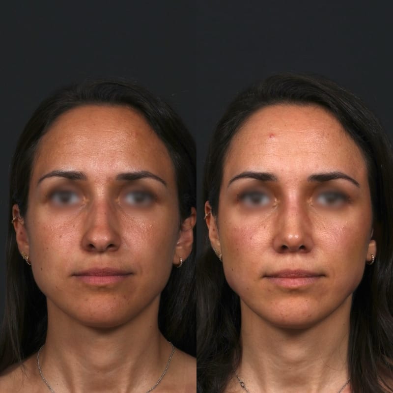Rhinoplastie vue de face, avant/après — pointe redéfinie et pyramide affinée