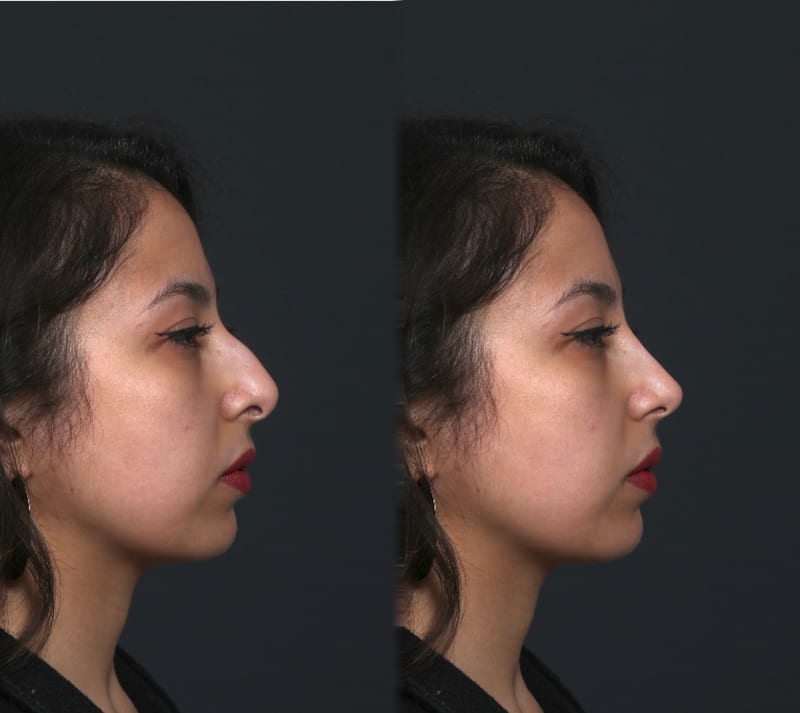 Simulation informatique avant / après d'une rhinoplastie de profil