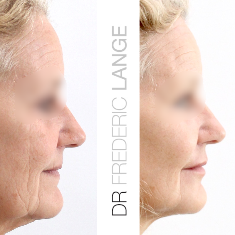IMG 4691 Lifting cervico facial