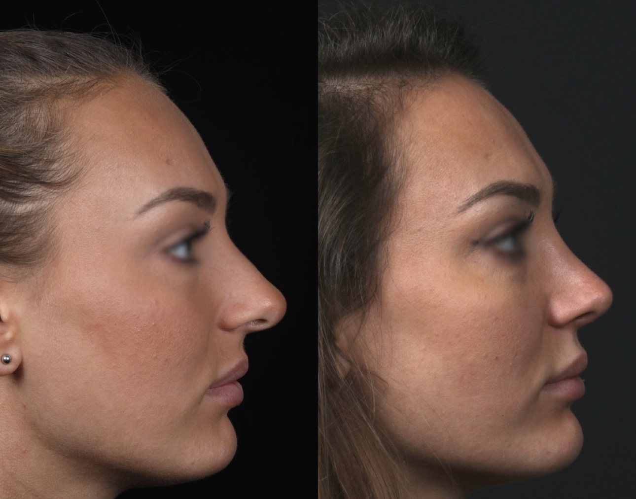 rhinoplastie naturelle