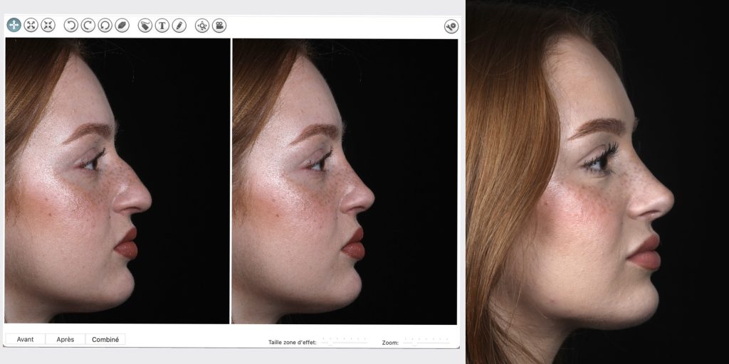 IMG 5091 1024x512 Puis je voir des simulations avant/après avant une rhinoplastie esthétique ?