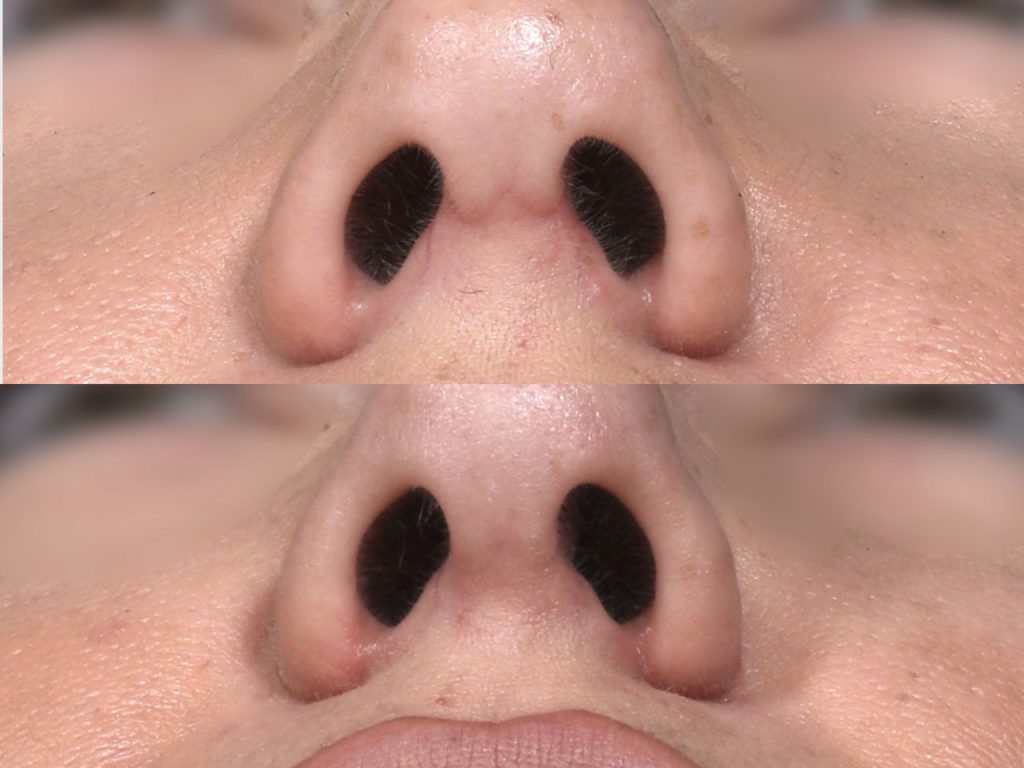 IMG 5165 1024x768 Rhinoplastie ouverte ou fermée : quelle technique choisir ?