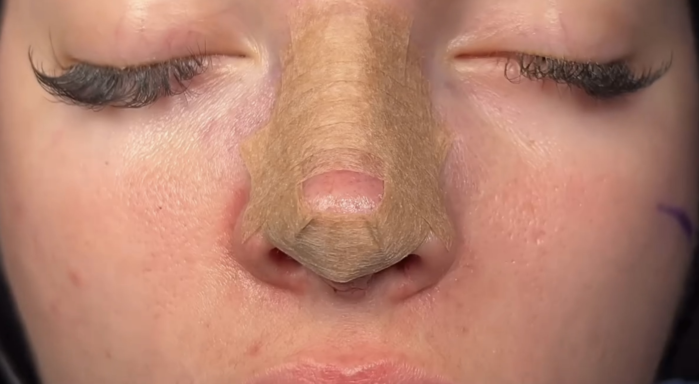 post opératoire rhinoplastie